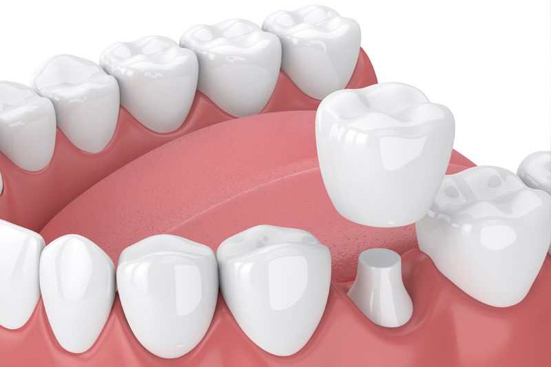 Dental Crowns in Milpitas