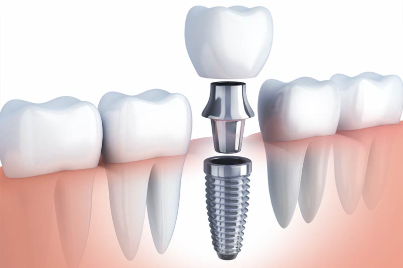 Implants Dentist in Milpitas