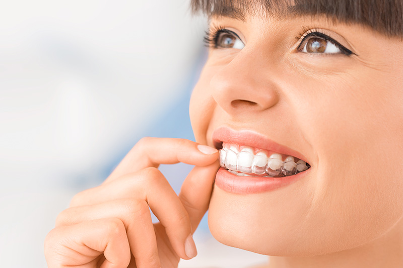 Invisalign in Milpitas