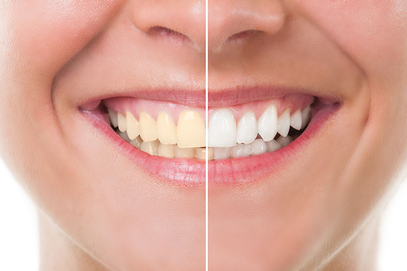 Teeth Whitening in Milpitas
