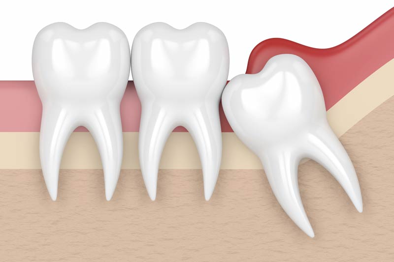 Wisdom Tooth Removal in Milpitas